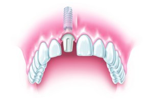 Implantologia dentale cosa e quando serve